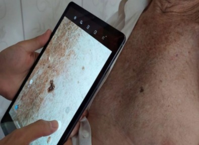 Avaliação de uma lesão Foto de uma mão segurando um celular apontado para uma lesão de pele em uma ação de avaliação