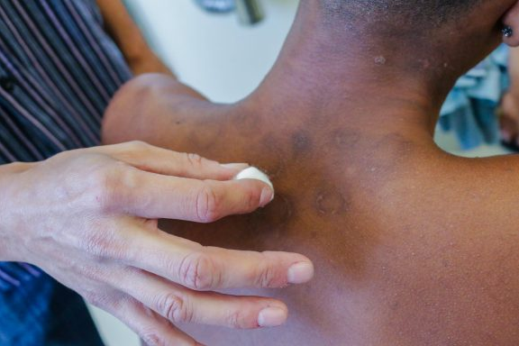 Foto de um homem negro com manchas na pele. Uma mulher parece passar um algodão sobre a mancha