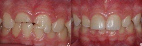 Foto de uma arcada dentária onde um dente da frente foi quebrado. A foto mostra a arcada antes e depois da reabilitação