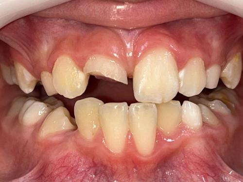 Foto da arcada dentária de uma pessoa com o dente da frente quebrado