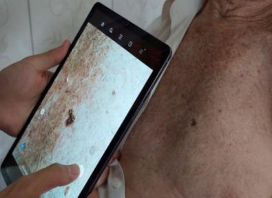 Avaliação de uma lesão Foto de uma mão segurando um celular apontado para uma lesão de pele em uma ação de avaliação